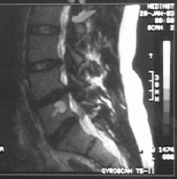 Hernie disc posterioara L4 si L5(MRI)