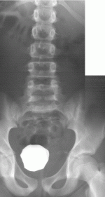 Spina bifida oculta S1