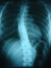 Scolioza dorsală dextroconvexă